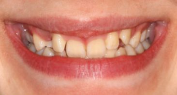 close of teenager with crooked teeth and tilted teeth prior to damon braces