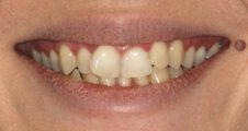 close up of crooked crossed over teeth prior to invisalign