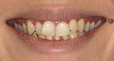 close up of crooked crossed over teeth prior to invisalign