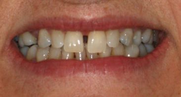 close up adult gaps between front teeth prior to invisalign