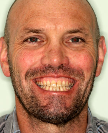 adult with corrected bite and straight teeth after damon braces