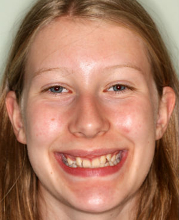 teenager very crooked tilted teeth prior to damon braces