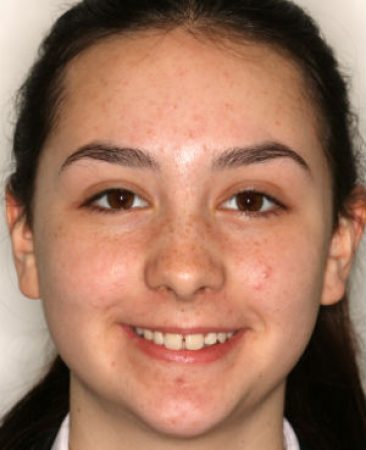 teenager, protruding teeth and gaps before braces