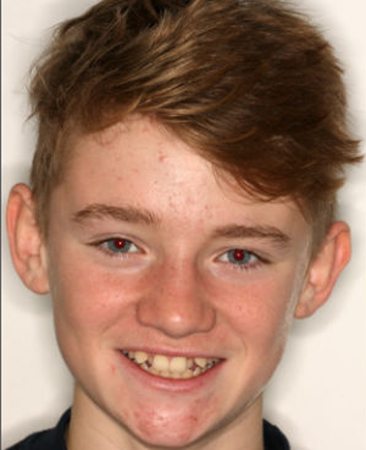 teenager with crooked overlapping teeth prior to damon braces