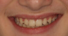 teenager close up of straight teeth after damon braces