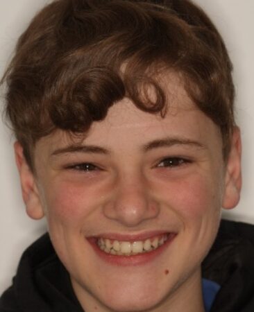 teenager after treatment with damon braces to straighten teeth