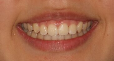 teenager straight teeth good bite after damon braces