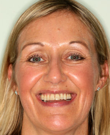 Adult patient after fixed braces with straighter teeth and improved bite balance