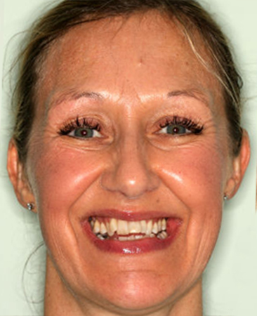 Adult patient before fixed braces with uneven smile and bite imbalance
