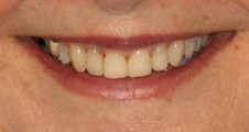 after fixed braces treatment – adult patient with straight teeth and broader smile