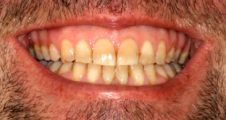 After fixed braces – corrected Class III bite and improved alignment