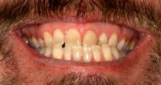 Before fixed braces – Class III underbite with reverse overjet