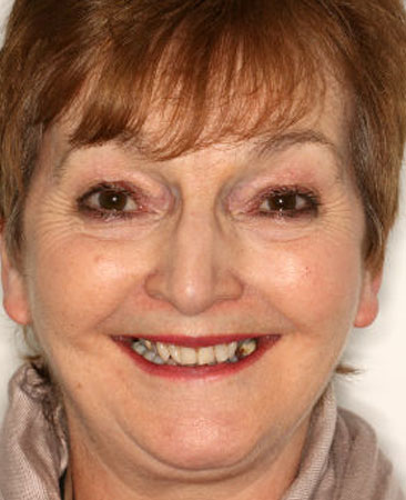 Before fixed braces treatment – adult patient with crowding and narrow smile