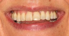 After fixed braces – improved alignment and corrected bite relationship