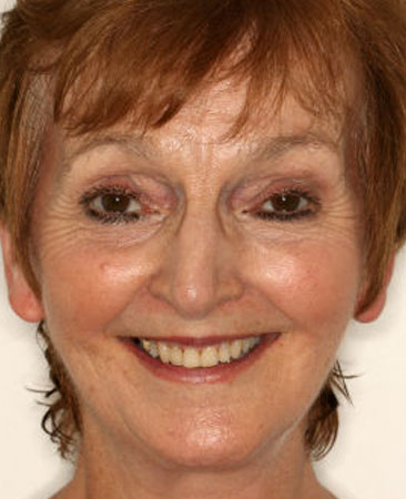 after fixed braces treatment – adult patient with straight teeth and broad smile