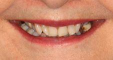 Before fixed braces treatment – adult patient with crowding and narrow smile