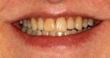 After Invisalign – aligned teeth and improved bite