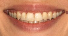 After Invisalign – improved alignment and bite balance