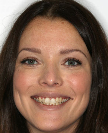 Before Invisalign treatment – adult female with moderate dental crowding in Fareham