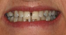 Before Invisalign – diastema and crooked front teeth