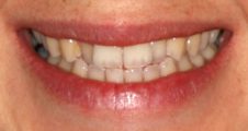Before Invisalign – misaligned upper front teeth