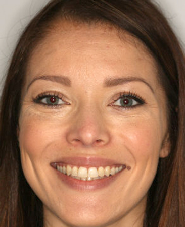 After Invisalign treatment – adult female with corrected crowding and straighter smile