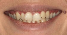 Before Invisalign – moderate crowding and bite irregularity