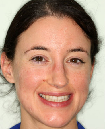 After Invisalign – improved smile symmetry and alignment