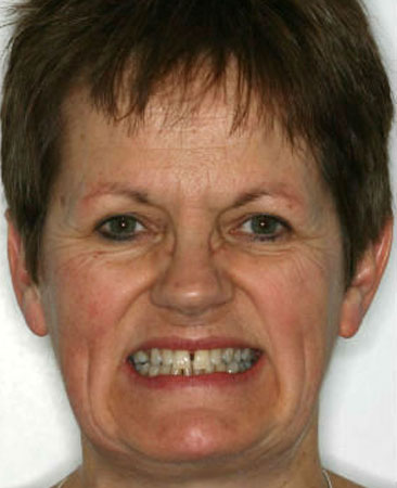 Before Invisalign – adult female with front tooth gap and mild crowding