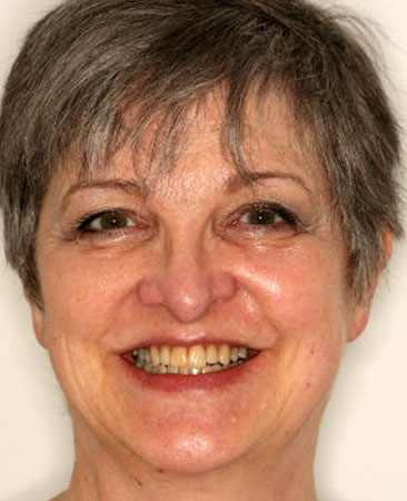 After Invisalign – improved tooth symmetry and balanced smile