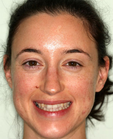 Before Invisalign – adult female with uneven front teeth alignment