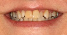 Before Invisalign – uneven incisor lengths and misalignment