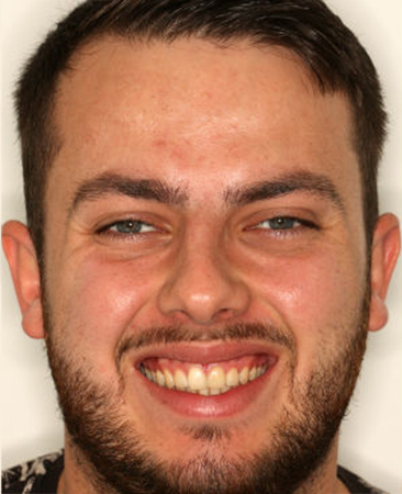 After Invisalign treatment – adult male with closed front tooth gap in Fareham