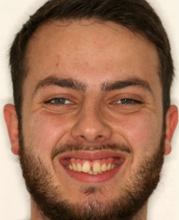 Before Invisalign treatment – adult male with front tooth gap (diastema) in Fareham