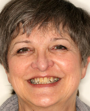 Before Invisalign – adult female with uneven front teeth and bite issue