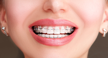 Damon braces orthodontic treatment at Pringle Orthodontics Fareham
