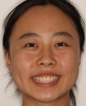 After braces – corrected deep bite and improved smile