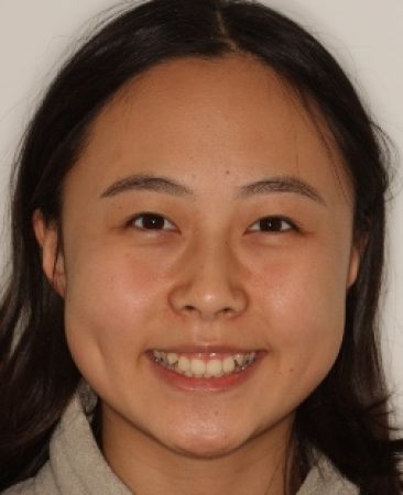 Before braces – teenage girl with Class II Division 2 bite