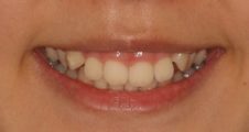Before braces – retroclined upper incisors and deep bite