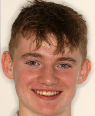 Teen after fixed braces with aligned front teeth and balanced smile