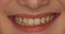 After fixed braces – corrected Class II bite and improved alignment