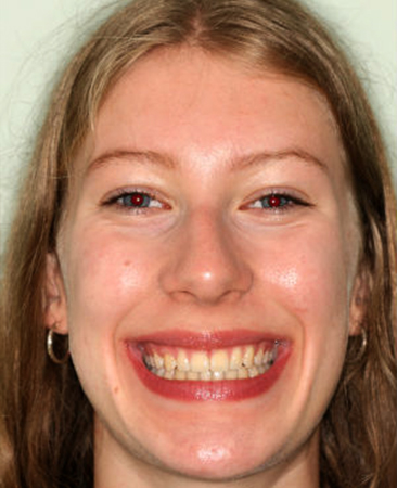 After fixed braces treatment – straighter smile and corrected bite