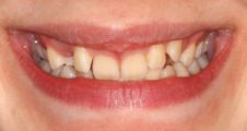 Before fixed braces – impacted canines, crowding and deep overbite
