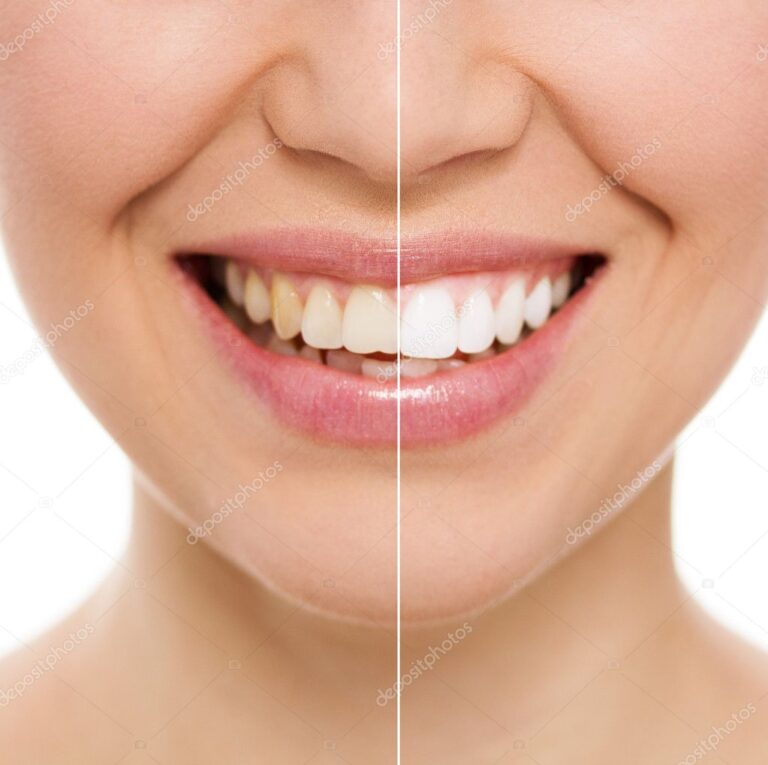 Tooth whitening after brace treatment Angus Pringle Orthodontics