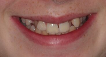 close up teenager crooked teeth, uneven smile, crossbite prior to invisalign