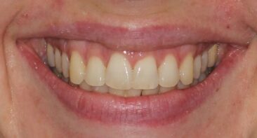 close up adult straight teeth after invisalign