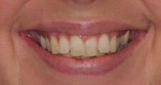 close up adult crooked teeth prior to invisalign