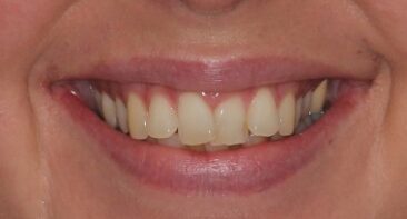 close up adult crooked teeth prior to invisalign