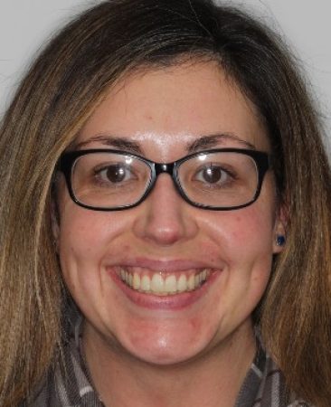 After Invisalign treatment – adult female with aligned teeth and balanced smile