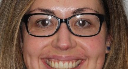 After Invisalign treatment – adult female with aligned teeth and balanced smile